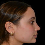 Rhinoplasty Before & After Patient #19388