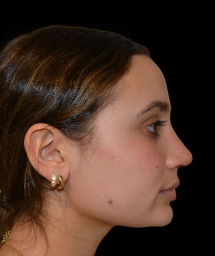 Rhinoplasty Before & After Patient #19388