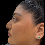 Liquid Rhinoplasty(Non-Surgical) Before & After Patient #19397