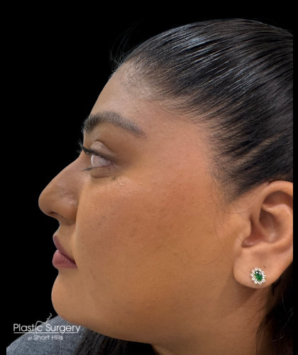 Liquid Rhinoplasty(Non-Surgical) Before & After Patient #19397