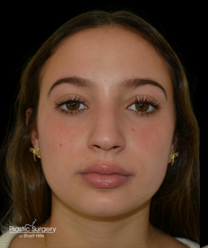 Rhinoplasty Before & After Patient #19388