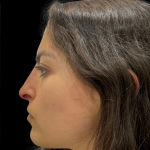 Liquid Rhinoplasty(Non-Surgical) Before & After Patient #19398