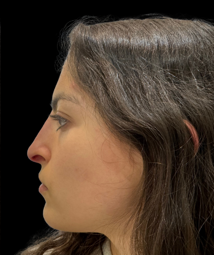 Liquid Rhinoplasty(Non-Surgical) Before & After Patient #19398