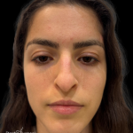 Liquid Rhinoplasty(Non-Surgical) Before & After Patient #19398