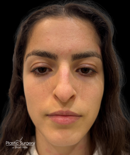 Liquid Rhinoplasty(Non-Surgical) Before & After Patient #19398