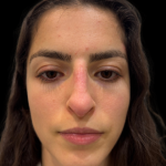 Liquid Rhinoplasty(Non-Surgical) Before & After Patient #19398