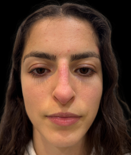 Liquid Rhinoplasty(Non-Surgical) Before & After Patient #19398