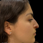 Liquid Rhinoplasty(Non-Surgical) Before & After Patient #19398