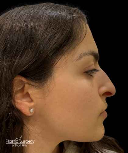 Liquid Rhinoplasty(Non-Surgical) Before & After Patient #19398