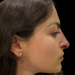 Liquid Rhinoplasty(Non-Surgical) Before & After Patient #19398