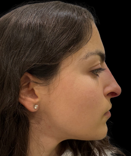 Liquid Rhinoplasty(Non-Surgical) Before & After Patient #19398