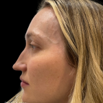 Liquid Rhinoplasty(Non-Surgical) Before & After Patient #19409