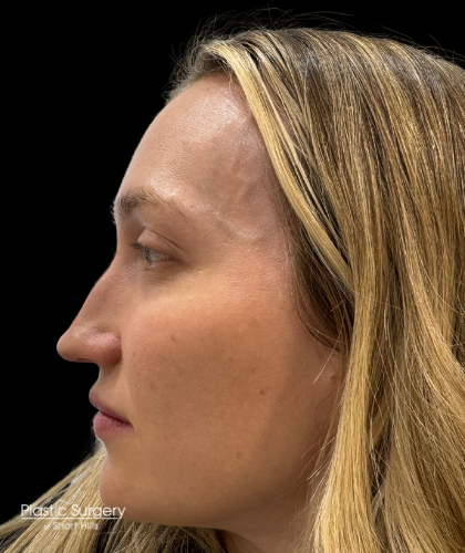 Liquid Rhinoplasty(Non-Surgical) Before & After Patient #19409