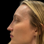 Liquid Rhinoplasty(Non-Surgical) Before & After Patient #19409