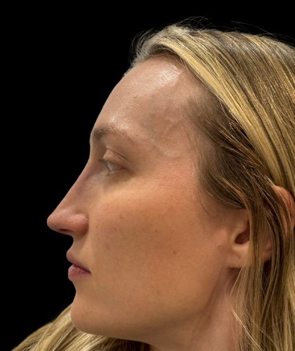 Liquid Rhinoplasty(Non-Surgical) Before & After Patient #19409