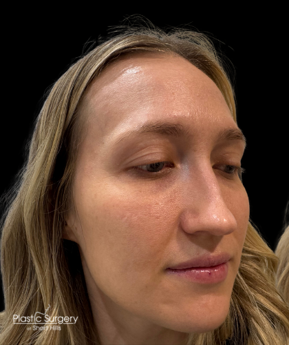 Liquid Rhinoplasty(Non-Surgical) Before & After Patient #19409