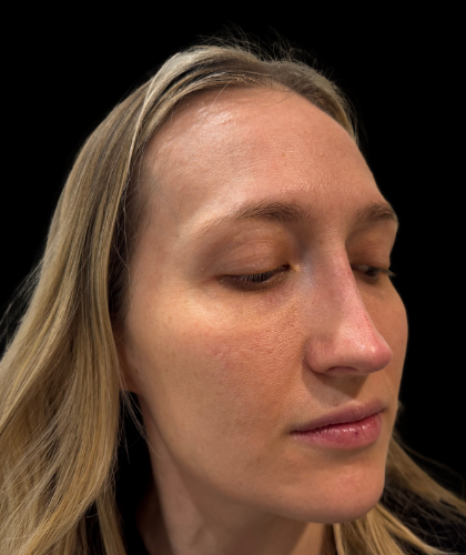 Liquid Rhinoplasty(Non-Surgical) Before & After Patient #19409