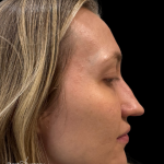 Liquid Rhinoplasty(Non-Surgical) Before & After Patient #19409