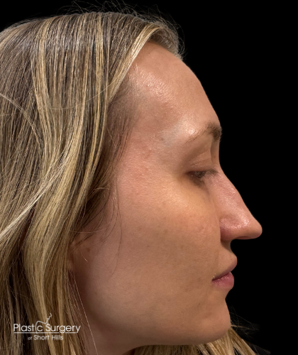 Liquid Rhinoplasty(Non-Surgical) Before & After Patient #19409