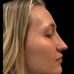 Liquid Rhinoplasty(Non-Surgical) Before & After Patient #19409