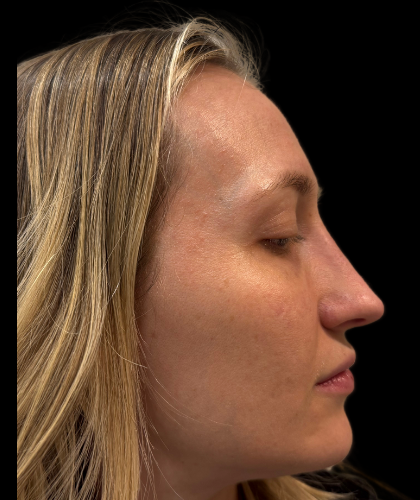 Liquid Rhinoplasty(Non-Surgical) Before & After Patient #19409